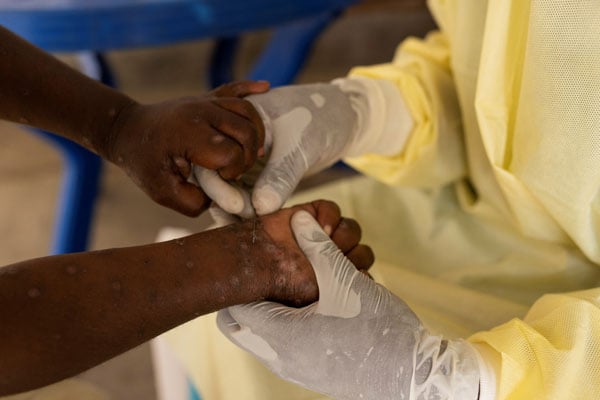 Mpox in Africa prompts $500 million funding from Gavi for vaccines